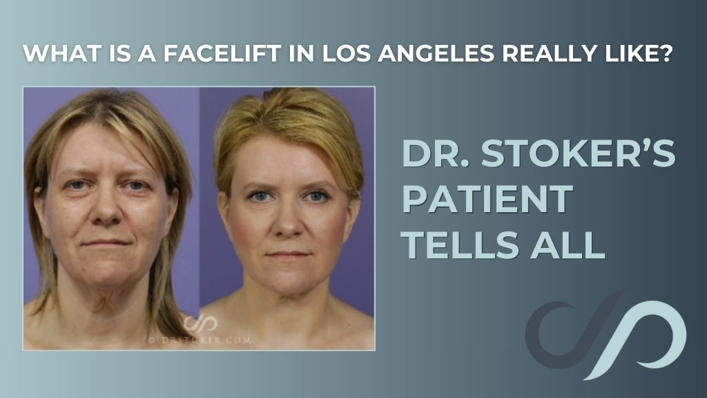 Real patient before and after image with text that reads 'What Is a Facelift in Los Angeles Really Like? Dr. Stoker’s Patient Tells All'