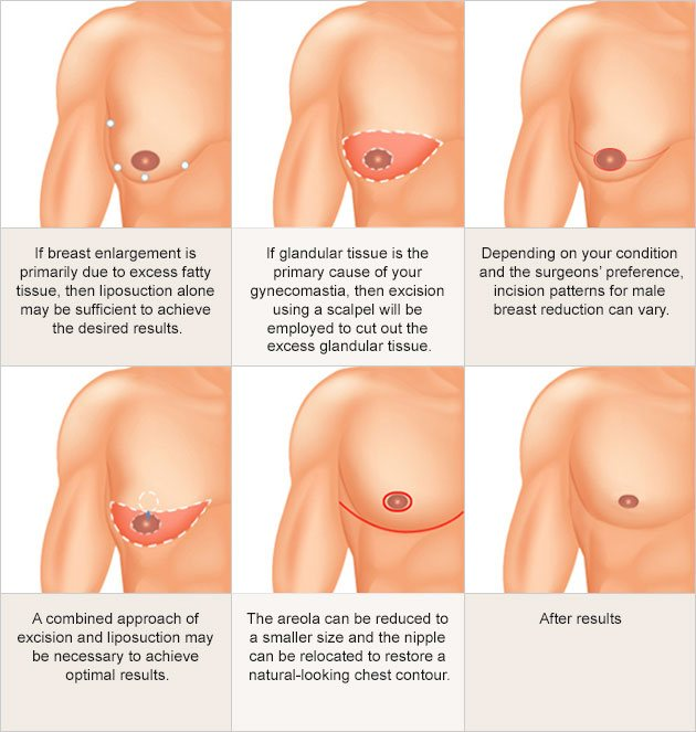 Breast enlargement in males Information