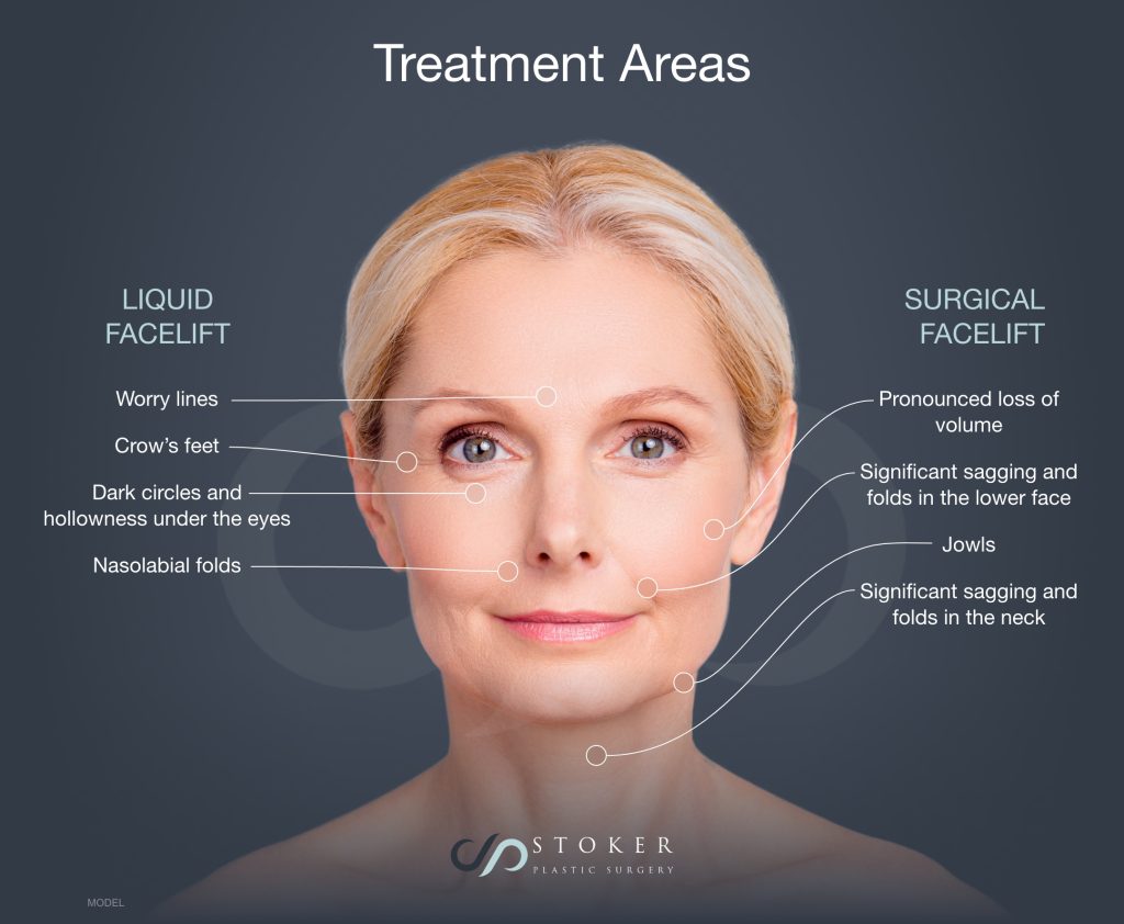 What's the Difference Between a Liquid Facelift and a Facelift? – Dr. David  Stoker