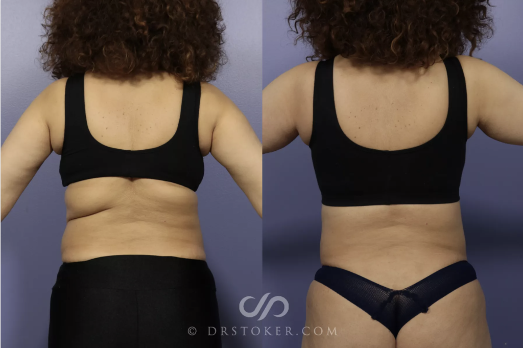 A Bra Line Back Lift Can Help You Look Your Best From Every Angle 