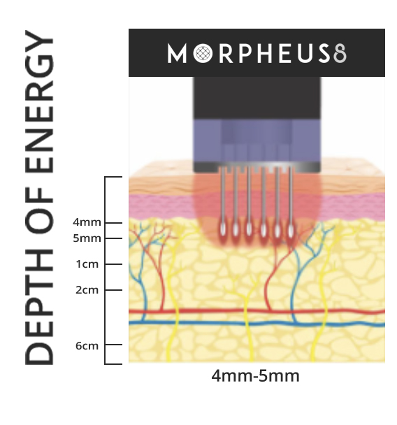 Morpheus8 Depth of Energy graphic