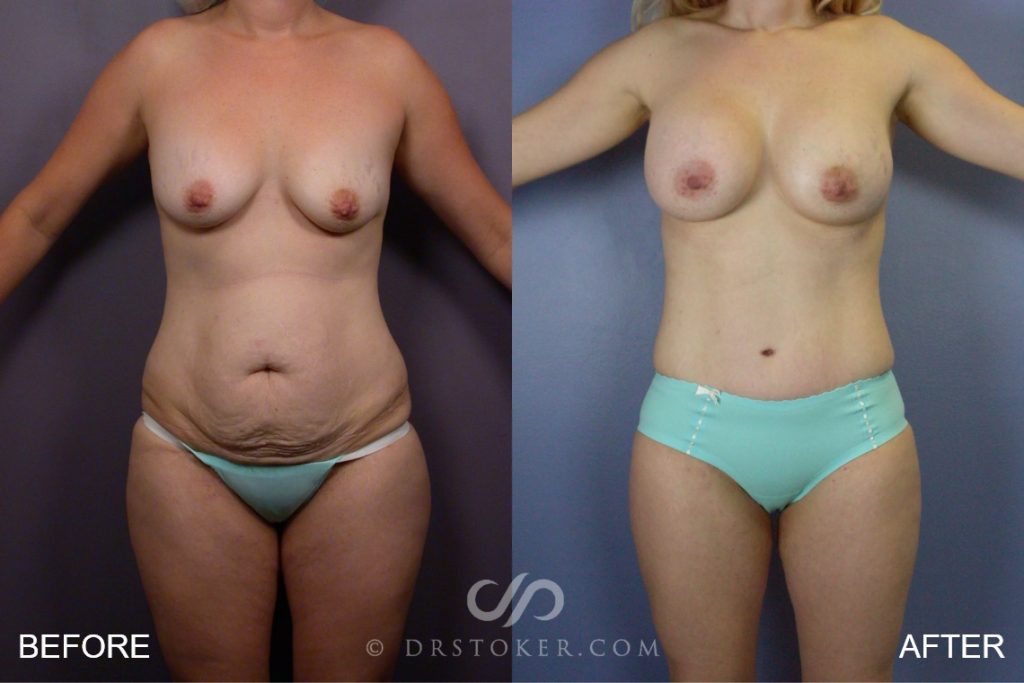 Case 241 Before & After Tummy Tuck