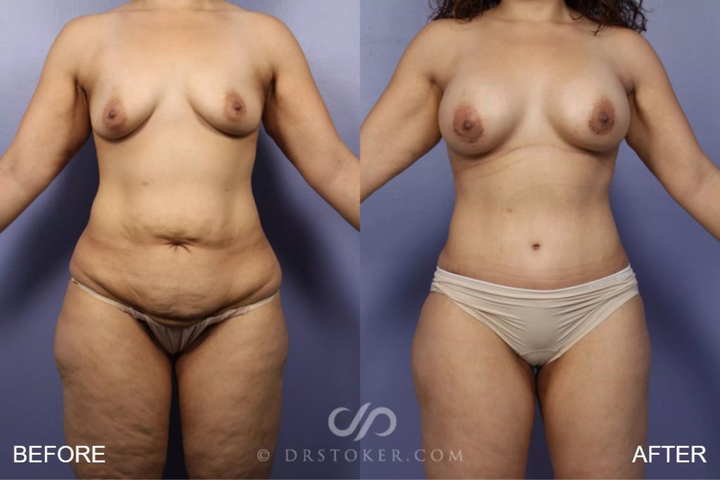 Case 346 Before & After Tummy Tuck