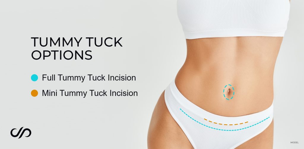 tummy tuck incision options