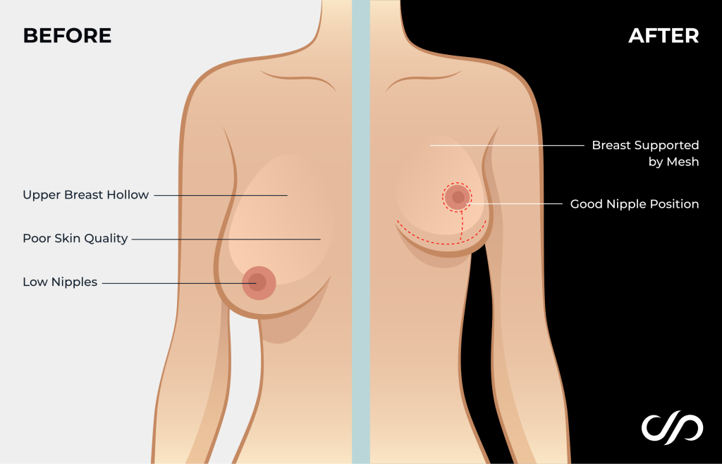 Graphic of breast before and after breast lift surgery.