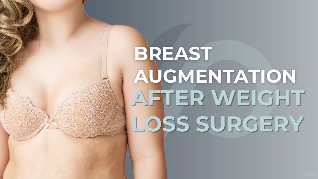 "Breast Augmentation After Weight Loss Surgery" Model image of a woman in a beige bra.