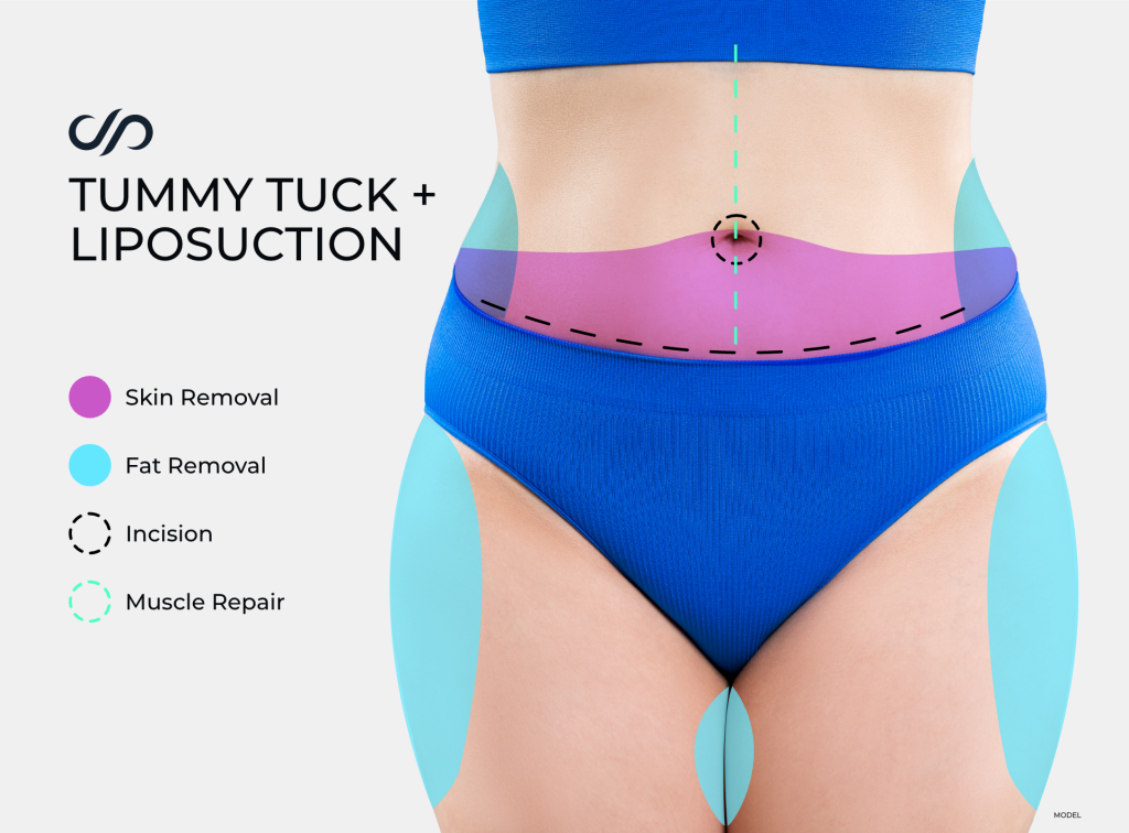 Infographic Tummy Tuck + Liposuction 