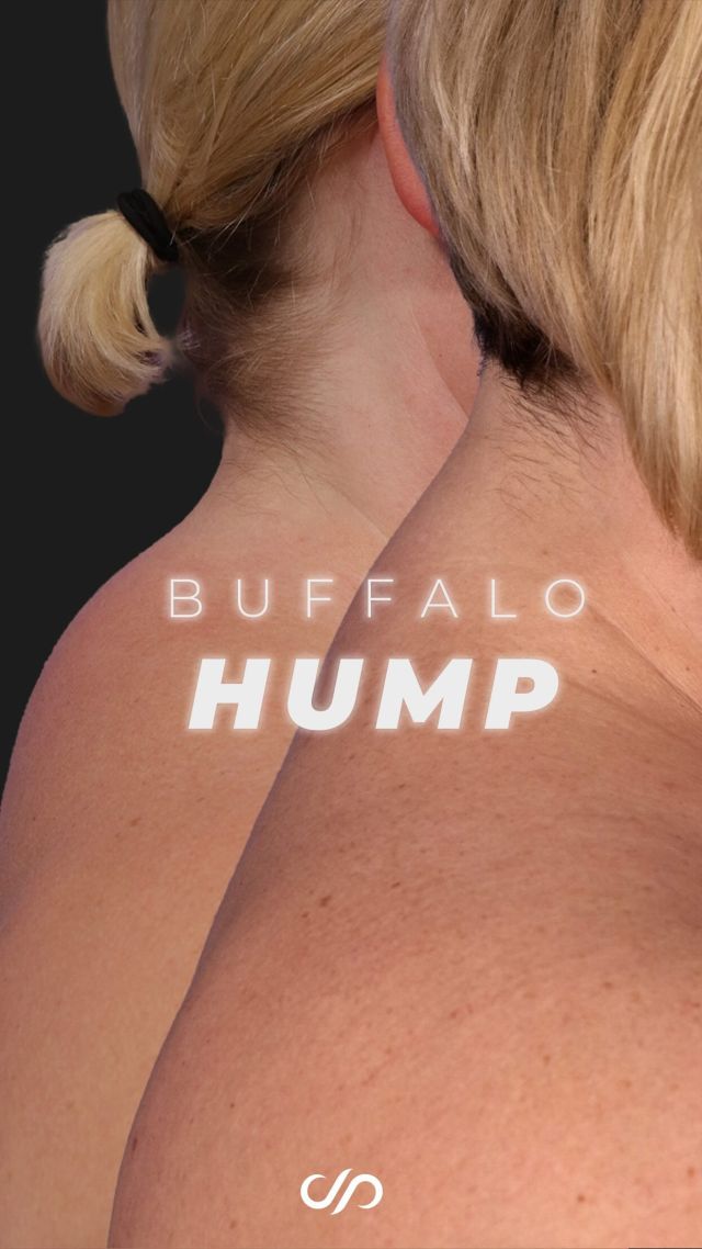 The Buffalo Hump Problem 🤯 // #liposuction 

💫 A buffalo hump is a buildup of excess fat located behind the neck, resulting in a hump-like appearance. Various underlying conditions can contribute to its development. Diagnosis is crucial before seeking treatment with us. If the hump is due to subcutaneous fat, liposuction can effectively remove it, enhancing the appearance of the area.

LEARN MORE ✨
Liposuction surgery is often a fantastic option for those who want to get rid of extra stubborn fat. The best candidates for this procedure are healthy adults with good skin elasticity and focal collections of diet-resistant fat. The surgery is excellent for fat removal and sculpting a patient’s optimal physique.

👋BOOK NOW | in-office or virtual appointments by sending your name, number, and email to the DM. 

📲 CALL US | questions regarding treatment: (310) 300-1779

📩Email: Info@drstoker.com

🛍 SHOP SKINCARE | Link in bio 🔗

COMMENT BELOW 🔽
.
.
.
.
#lipo #humpday #buffalohump  #plasticsurgery #plasticsurgeon  #fatremoval #skintightening #beforeandafter #beforeandaftersurgery #bodycontouring #bodygoals  #transformation #recoverytime #liposculpture #boardcertified #boardcertifiedplasticsurgeon #drdavidstoker #results #powerassistedliposuction