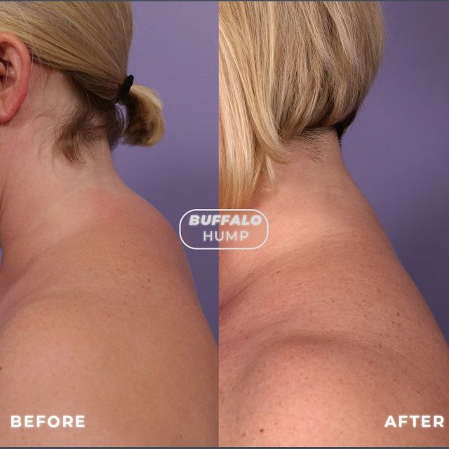 Buffalo Hump 🦬 // #liposuction 

🔥The patient developed a buffalo hump, an accumulation of fat at the neck and upper back base, often seen as a prominent bulge above the shoulders, linked to specific medical conditions. We used a small incision near the hump’s base, employing a cannula to remove excess fat and ensure a natural, pleasing contour.

👋BOOK NOW | in-office or virtual appointments by sending your name, number, and email to the DM. 

📲 CALL US | questions regarding treatment: (310) 300-1779

📩Email: Info@drstoker.com

🛍 SHOP SKINCARE | Link in bio 🔗

COMMENT BELOW 🔽
.
.
.
.
#lipo #humpday #buffalohump  #plasticsurgery #plasticsurgeon  #fatremoval #skintightening #beforeandafter #beforeandaftersurgery #bodycontouring #bodygoals  #transformation #recoverytime #liposculpture #boardcertified #boardcertifiedplasticsurgeon #drdavidstoker #results #powerassistedliposuction