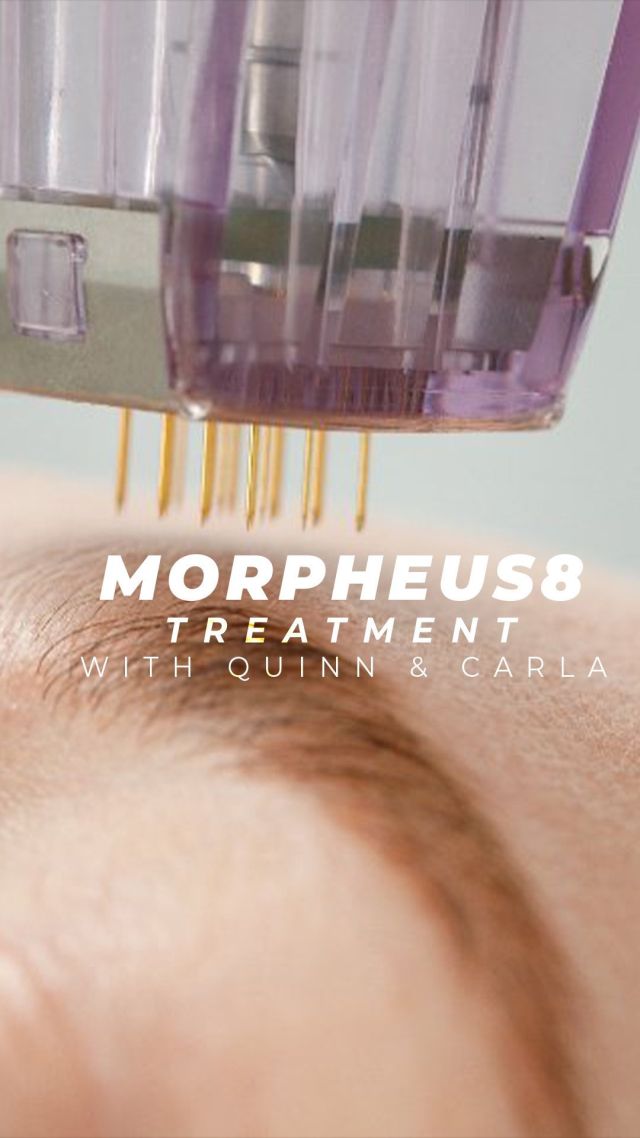 Summer Glow-Up Special ✨💫 // #morpheus8 

✨ Buy 1 Morpheus8 treatment, get the 2nd 50% off!
✨ Valid for purchases made from 7/19/24 to 10/1/24

💜Don’t miss out on this limited-time offer! Rejuvenate your skin and boost your confidence this summer with Morpheus8.

👋BOOK NOW | In-office or virtual appointments by sending your name, number, and email to the DM. 

📲 CALL US | questions regarding treatment: (310) 300-1779

📩Email: Info@drstoker.com

🛍 SHOP SKINCARE | Link in bio 🔗

COMMENT BELOW 🔽
.
.
.
.
#dermalfiller #botox #beauty #antiaging #aesthetics #fillers #undereyefiller #dermalfiller #medicalspa #juvederm #skin #lipfiller #injectables #plasticsurgery #facial #cheekfiller #lips #esthetician #aestheticsexpert #facials #dermalfillers #selfcare #microneedling #dysport #bodycontouring #restylane #laser #skincareroutine #promotion