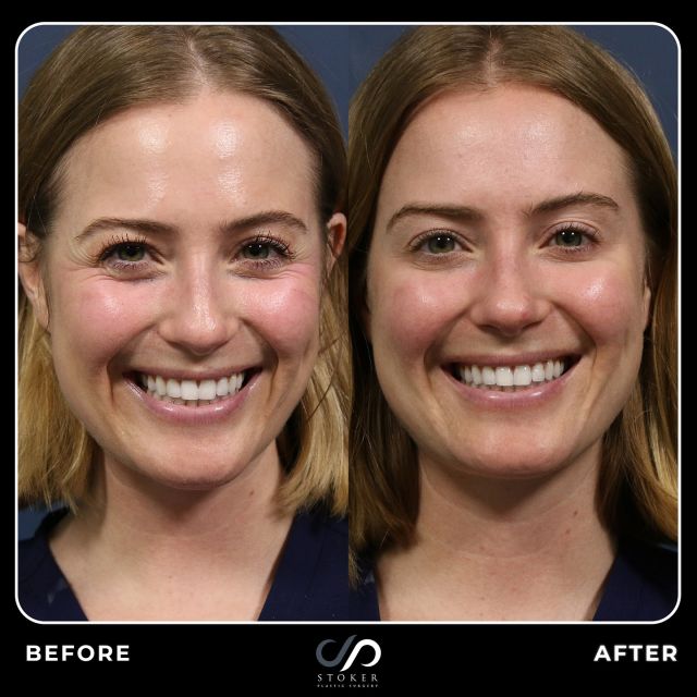 Botox Rejuvenation 💉🥰 // #botox #crowsfeet 

RESULTS💕
💖Reduced Crow’s Feet Around the Eyes
💖Smoother Skin Texture
💖Youthful & Refreshed Appearance
💖Enhanced Natural Beauty

👋Our patient achieved remarkable results with Botox treatments. As seen in the before and after photos, her crow’s feet and fine lines around her eyes have significantly diminished, leaving her with a smoother, more youthful appearance. Botox effectively softened these wrinkles, enhancing her natural beauty while maintaining a fresh, expressive look. These subtle yet impactful changes showcase the power of Botox in restoring a more vibrant and refreshed facial appearance.

👋BOOK NOW | For in-office or virtual appointments, send your name, number, and email to the DM. 

📲 CALL US | questions regarding treatment: (310) 300-1779

📩Email: Info@drstoker.com

🛍 SHOP SKINCARE | Link in bio 🔗

COMMENT BELOW 🔽
.
.
.
.
#preventativebotox #botox #antiaging #dysport #skincare #botoxinjections #injectables #injections #botoxforehead #wrinkles #frownlines #beauty #fillers #xeomin #aesthetics #beforeandafter #wrinklefree #refresh #prevention #botoxbeforeandafter #botoxcosmetic #medspa #rejuvenation
