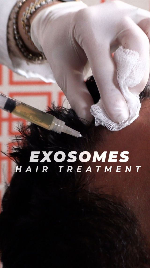 Exosome Therapy for Hair Growth ✨// #exosome #exosometherapy

🔥Utilizes Stem Cells 
🔥Minimally Invasive Treatment
🔥Boosts Collagen Production

✨Exosome therapy utilizes stem cells to revitalize hair follicles. By injecting exosomes into thinning scalp areas, this treatment boosts hair density and strength, fostering healthier and more robust hair growth. Patients often see visible improvements within three months.

👋BOOK NOW | In-office or virtual appointments by sending your name, number, and email to the DM. 

📲 CALL US | questions regarding treatment: (310) 300-1779

📩Email: Info@drstoker.com

🛍 SHOP SKINCARE | Link in bio 🔗

COMMENT BELOW 🔽
.
.
.
.
#juvederm #botox #fillers #lipfiller #restylane #beauty #filler #aesthetics #skincare #dermalfillers #lipfillers #lipinjections #antiaging #injectables #dysport #allergan #medspa #microneedling #voluma #lipenhancement #plasticsurgery #beforeandafter #dermalfiller #aesthetic #cheekfiller #prp