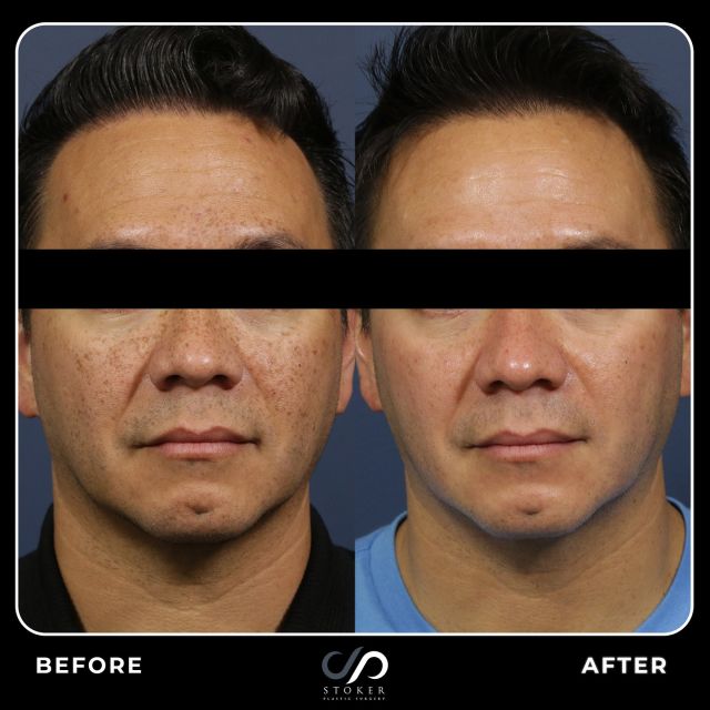 Melanage Peel Transformative Results 😉// #rejuvenation
 
✅Our Melanage Peel effectively targets stubborn pigmentation and melasma, offering impressive improvements in skin tone, fine lines, and texture.

🌟Pigmentation Reduction: Noticeably reduces dark spots and uneven skin tone.
🌟Enhanced Skin Texture: Smooths the skin, reducing the appearance of fine lines and creating a more refined look.
🌟Safe for All Skin Types: Suitable for a variety of skin types, providing comprehensive skin rejuvenation.
🌟Visible Transformation: Achieve a clearer, more even complexion with significant results.

👉Experience for yourself the transformative benefits of the Melanage Peel for a healthier, more radiant appearance. Visit us at drstoker.com to learn more.

👋BOOK NOW | in-office or virtual appointments by sending your name, number, and email to the DM.

📲 CALL US | questions regarding treatment: (310) 300-1779

🛍 SHOP SKINCARE | Link in bio 🔗

COMMENT BELOW ⬇️ 
.
.
.
.
#beauty #botox #antiaging #skincare #beforeandafter #aesthetics #skintightening  #aesthetic #skin #melanagepeel #chemicalpeel #beforeandafter #melasma #finelines #melasmatreatment #chemicalpeels #pigmentation #wrinkles #sundamage #facial  #injector #nurseinjector #aesthetician #allergan  #esthetician #skinmedicapeel #happypeeling #peelseason #cosmelanpeel
