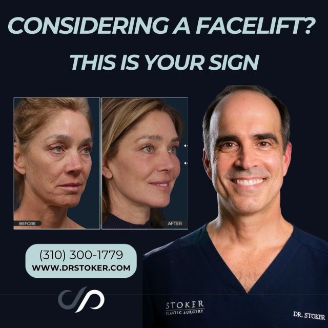 Our Traceless Facelift 🥰// #facelift #necklift

Benefits of Facelift Surgery 👇
💜 Reduced Appearance of Fine Lines and Wrinkles
💜 Improved Facial Contours and Symmetry
💜 Youthful and Natural-Looking Results
💜 Boosted Confidence and Self-Esteem

😉Looking for a more youthful and refreshed appearance? Our face and neck lift surgery can help you turn back the clock and rejuvenate your appearance.

👋BOOK NOW | in-office or virtual appointments by sending your name, number, and email to the DM. 

📲 CALL US | questions regarding treatment: (310) 300-1779

📩Email: Info@drstoker.com

🛍 SHOP SKINCARE | Link in bio 🔗

COMMENT BELOW 🔽
.
.
.
.
#tracelessfacelift #facelift #necklift #skincare #cheeklift #lowerfacelift #laserskinresurfacing #blepharoplasty #upperbleph #uppereyelid #eyelidsurgery  #co2 #chinaugmentation #skinrejuvenation #skintightening  #cosmeticsurgery #wrinkles  #surgery #rejuvenation #skin #plasticsurgeon #transformation #plasticsurgery