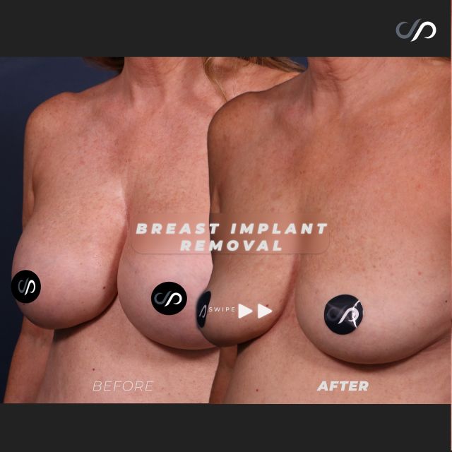 Breast Implant Removal 🍒💕 // #breastimplants

What Was The Outcome? ⬇️
✅Natural & Perky Appearance
✅Improved Posture
✅Rapid And Comfortable Recovery
✅Minimal Scarring With Small Incision

💜BOOK NOW | in-office or virtual appointments by sending your name, number, and email to the DM.

📲 CALL US | questions regarding treatment: (310) 300-1779

🛍 SHOP SKINCARE | Link in bio 🔗

COMMENT BELOW ⬇️  .
.
.
.
#boobjob #breastimplants #gummybearimplants #breastimplantremoval #breastrevision  #beforeandafter #breastsurgery #breastimplants 	#cosmeticsurgery #plasticsurgery #boobjobexpert #breastaugmentationexpert #boardcertified #boardcertifiedplasticsurgeon #mastopexy #breastaug #breastreconstruction #plasticsurgeon #saggingbreast #breastlift #drstoker #postop #postopsurgery #beforeandaftersurgery