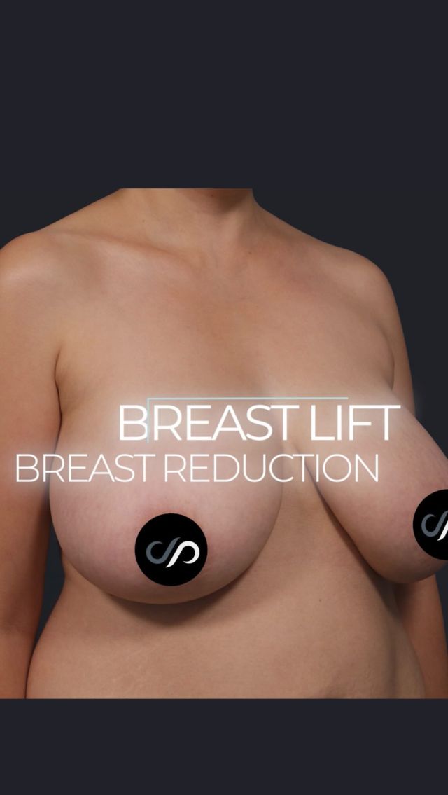 Breast Lift 💞🍒 // #breastreduction 

RESULTS 💖
💕Improved Shape and Size
💕Enhanced Confidence & Self-Esteem
💕Correction Of Breast Asymmetry

👋This 43-year-old mother had a bilateral breast reduction with impressive results. After removing about 600 grams from each side, she now enjoys enhanced fullness in the upper breast area and a significantly smaller size overall. The breast tissue is seamlessly blended with discreet incisions, leaving her breasts high, tight, and perky. Her satisfaction with the results is evident.

BOOK NOW | in-office or virtual appointments by sending your name, number, and email to the DM.

📲 CALL US | questions regarding treatment: (310) 300-1779

🛍 SHOP SKINCARE | Link in bio 🔗

COMMENT BELOW ⬇️  .
.
.
.
#boobjob #breastimplants #gummybearimplants #breastimplantreplacement  #breastrevision  #beforeandafter #breastsurgery #breastimplants 	#cosmeticsurgery #plasticsurgery #boobjobexpert #breastaugmentationexpert #boardcertified #boardcertifiedplasticsurgeon #mastopexy #breastaug #breastreconstruction #plasticsurgeon #saggingbreast #breastlift #drstoker