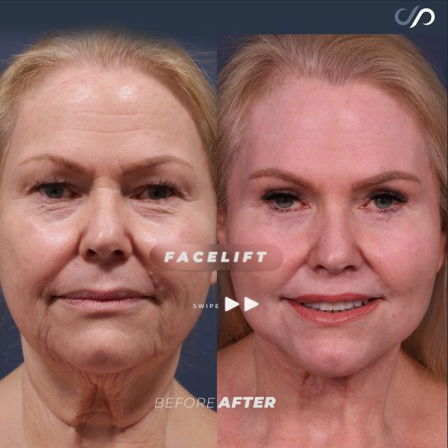 Amazing Traceless Facelift w/ CO2 Laser Resurfacing ✨👩✨ // #facelift  #beforeandafter 

RESULTS🔥
💜Lifted And Tightened Facial Contours
💜Improved Upper Eyelid And Lip Appearance
💜Enhanced Chin Definition And Profile
💜Reduced Buccal Fat For A Slimmer Face
💜Diminished Neck Wrinkles & Sagging

😍Our patient achieved a remarkable transformation with a Traceless Facelift enhanced by CO2 laser resurfacing. The procedure also included an upper eyelid lift, upper lip lift, neck lift, chin augmentation, and buccal fat reduction. 

✅This comprehensive approach lifts and repositions facial tissues, tightens underlying muscles, and removes excess skin for a revitalized appearance. The CO2 laser treatment improves skin elasticity and reduces wrinkles, especially around the neck. Incisions are strategically placed to keep scars nearly invisible, delivering a refreshed, natural-looking result.

👋BOOK NOW | In-office or virtual appointments by sending your name, number, and email to the DM.

📲 CALL US | questions regarding treatment: (310) 300-1779

🛍 SHOP SKINCARE | Link in bio 🔗 

COMMENT BELOW 🔽
.
.
.
.
#tracelessfacelift #facelift #necklift #skincare #cheeklift #lowerfacelift #laserskinresurfacing #blepharoplasty #upperbleph #uppereyelid #eyelidsurgery  #co2laser #chinaugmentation #skinrejuvenation #skintightening  #cosmeticsurgery #wrinkles  #surgery #rejuvenation #skin #plasticsurgeon #transformation #plasticsurgery