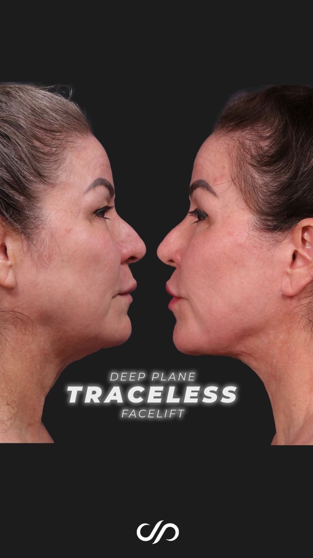 Traceless Facelift w/ CO2 Laser Resurfacing ✨👩✨ // #facelift  #beforeandafter 

✨Today marks one and a half years since we performed a traceless deep plane face and neck lift, upper eyelid surgery, upper lip lift, and fractional CO2 laser resurfacing on a 61-year-old woman. Her results are exceptional. Her bright eyes, naturally full lips, and flawless jawline highlight the success of these procedures. The traceless technique ensures the incisions are invisible, and the laser resurfacing has beautifully refined her skin. This is truly a tremendous success.

👋BOOK NOW | In-office or virtual appointments by sending your name, number, and email to the DM.

📲 CALL US | questions regarding treatment: (310) 300-1779

🛍 SHOP SKINCARE | Link in bio 🔗 

COMMENT BELOW 🔽
.
.
.
.
#tracelessfacelift #facelift #necklift #skincare #cheeklift #lowerfacelift #laserskinresurfacing #blepharoplasty #upperbleph #uppereyelid #eyelidsurgery  #co2laser #chinaugmentation #skinrejuvenation #skintightening  #cosmeticsurgery #wrinkles  #surgery #rejuvenation #skin #plasticsurgeon #transformation #plasticsurgery