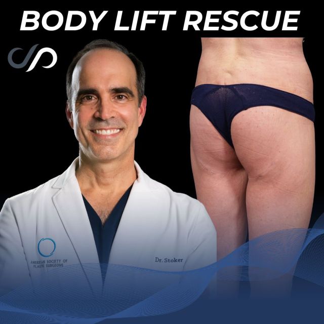 Body Lift Rescue 💞👙🛠️// #bodylift #transformation

✨We have an impressive transformation, effectively addressing sagging skin, dimpling, and wrinkles around the lower back, buttocks, and thighs. The results reveal firmer contours, a noticeable lift to the buttocks, and smoother, more toned skin. This comprehensive approach rejuvenates the body’s overall appearance, delivering a more sculpted and youthful silhouette.

✅For more information on our body lift surgery or any other procedure, visit us at drstoker.com, where we have an extensive database of educational content, including our patients’ before and after results. 

BOOK NOW | In-office or virtual appointments by sending your name, number, and email to the DM.

📲 CALL US | questions regarding treatment: (310) 300-1779

🛍 SHOP SKINCARE | Link in bio 🔗

COMMENT BELOW 🔽
.
.
.
.
#skintightening  #bodytransformation #bbl #buttlift #buttockslift #plasticsurgery #lowerbody #tummytuck #plasticsurgeon #abdominoplasty #cosmeticsurgery #surgery #mommymakeover #beauty #physique #weightloss #weightlosstransformation #beforeandafter #bodycontouring #body #thighlift #boardcertifiedplasticsurgeon #bodyshaping #bodygoals #fitness