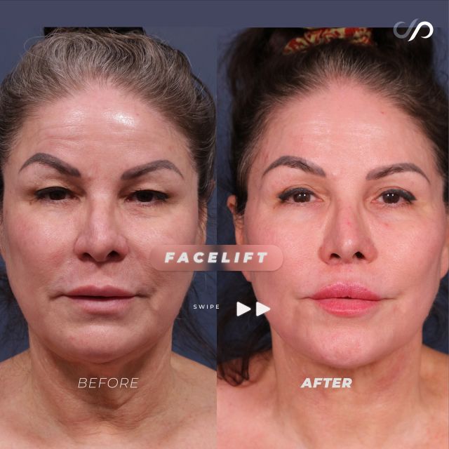 Traceless Facelift Results 😉✨ // #facelift  #beforeandafter 

✨This 61-year-old patient experienced an incredible transformation after undergoing a traceless deep plane face and neck lift, upper eyelid surgery, upper lip lift, and fractional CO2 laser resurfacing. 

💖The results speak for themselves: bright, refreshed eyes, naturally fuller lips, and a beautifully defined jawline. The traceless technique ensured no visible scars, while the CO2 laser resurfacing enhanced her skin’s texture for a smooth and youthful appearance. An impressive and beautifully natural result!

👋BOOK NOW | In-office or virtual appointments by sending your name, number, and email to the DM.

📲 CALL US | questions regarding treatment: (310) 300-1779

🛍 SHOP SKINCARE | Link in bio 🔗 

COMMENT BELOW 🔽
.
.
.
.
#tracelessfacelift #facelift #necklift #skincare #cheeklift #lowerfacelift #laserskinresurfacing #blepharoplasty #upperbleph #uppereyelid #eyelidsurgery  #co2laser #chinaugmentation #skinrejuvenation #skintightening  #cosmeticsurgery #wrinkles  #surgery #rejuvenation #skin #plasticsurgeon #transformation #plasticsurgery