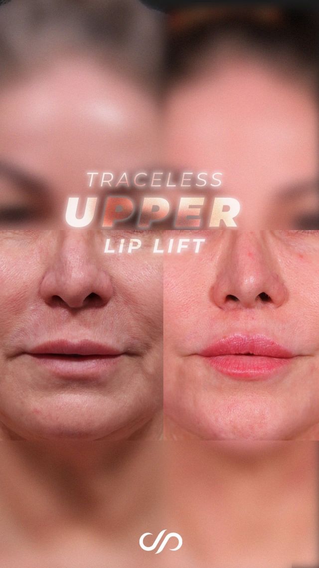 Traceless Upper Lip Lift 🫦✨// #rejuvenation

RESULTS 💜
🪄Youthful, defined Cupid’s bow
🪄Enhanced pink vermilion
🪄Improved Facial Proportions
🪄Undetectable Procedure

💫We performed an upper lip lift as part of the facelift, with the scar hidden discreetly near the nose. The results are impressive: her lip has a youthful, defined Cupid’s bow and enhanced pink vermilion. The lift significantly improves the overall facial appearance while remaining virtually undetectable.

💕BOOK NOW | In-office or virtual appointments by sending your name, number, and email to the DM.

📲 CALL US | questions regarding treatment: (310) 300-1779

🛍 SHOP SKINCARE | Link in bio 🔗

COMMENT BELOW ⬇️ 
.
.
.
.
#tracelessfacelift #facelift #necklift #skincare #cheeklift #lowerfacelift #laserskinresurfacing #blepharoplasty #upperbleph #uppereyelid #eyelidsurgery  #co2 #chinaugmentation #skinrejuvenation #skintightening  #cosmeticsurgery #wrinkles  #surgery #rejuvenation #skin #plasticsurgeon #transformation #plasticsurgery