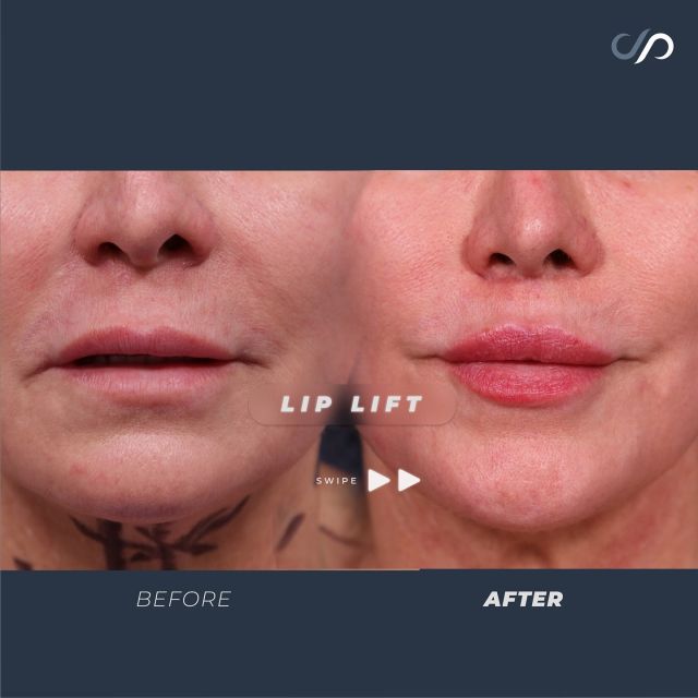 Upper Lip Lift 💕👄💕// #rejuvenation

RESULTS 💜
✨Improved Cupid’s Bow
✨Fuller Lips
✨Shortened Philtrum 

💋 We performed an upper lip lift with the scar discreetly hidden near the nose. The results are impressive. Her lips now have a beautifully improved Cupid’s bow, appear fuller, and have a shortened philtrum. This lift significantly enhances the overall look of her lips while remaining virtually undetectable.

👋BOOK NOW | In-office or virtual appointments by sending your name, number, and email to the DM.

📲 CALL US | questions regarding treatment: (310) 300-1779

🛍 SHOP SKINCARE | Link in bio 🔗

COMMENT BELOW ⬇️ 
.
.
.
.
#tracelessfacelift #facelift #necklift #skincare #cheeklift #lowerfacelift #laserskinresurfacing #blepharoplasty #upperbleph #uppereyelid #eyelidsurgery  #co2 #chinaugmentation #skinrejuvenation #skintightening  #cosmeticsurgery #wrinkles  #surgery #rejuvenation #skin #plasticsurgeon #transformation #plasticsurgery