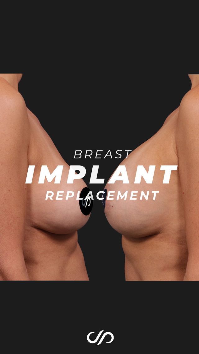 Breast Implant Replacement ✨🍒💞 // #breastimplants

💜We’re thrilled to showcase a fantastic four-month result for a patient in her late 40s who upgraded her deflated saline implants. We replaced her original 325 cc implants with the latest cohesive silicone gel implants, increasing her size to 550 cc. 

👑She looks incredible. Despite being a busy executive concerned about recovery time, she had a smooth and easy process.

👋BOOK NOW | in-office or virtual appointments by sending your name, number, and email to the DM.

📲 CALL US | questions regarding treatment: (310) 300-1779

🛍 SHOP SKINCARE | Link in bio 🔗

COMMENT BELOW ⬇️  .
.
.
.
#boobjob #breastimplants #gummybearimplants #breastimplantremoval #breastrevision  #beforeandafter #breastsurgery #breastimplants 	#cosmeticsurgery #plasticsurgery #boobjobexpert #breastaugmentationexpert #boardcertified #boardcertifiedplasticsurgeon #mastopexy #breastaug #breastreconstruction #plasticsurgeon #saggingbreast #breastlift #drstoker #postop #postopsurgery #beforeandaftersurgery