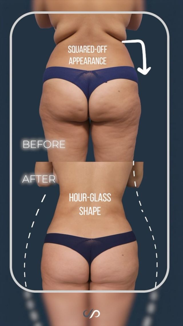 Are You A Candidate for Liposuction? 🤔 🛠️ // #liposuction 

WHY?
🔥Fat Reduction
🔥Lasting Results
🔥Enhanced Physique

🚨The ideal candidates for liposuction exhibit good skin elasticity, particularly those with firm and elastic skin, often experiencing favorable outcomes. Older individuals or those with diminished skin elasticity might find this procedure less suitable. Recovery is usually quick, with many returning to work within a day or two. Any temporary soreness is overshadowed by the satisfaction of observing enduring fat removal results in the mirror.

✅Visit our website, drstoker.com, to learn more about our surgical procedures and determine which one is best for you. 

 BOOK NOW | In-office or virtual appointments by sending your name, number, and email to the DM. 

📲 CALL US | questions regarding treatment: (310) 300-1779

📩Email: Info@drstoker.com

🛍 SHOP SKINCARE | Link in bio 🔗

COMMENT BELOW 🔽 .
.
.
.
#skintightening #abdominoplasty #bodytransformation #plasticsurgery #lowerbody #plasticsurgeon #extendedabdominoplasty  #cosmeticsurgery #surgery #mommymakeover #bodycontouring #breastaugmentation #breastlift  #weightloss #extrememakeover #weightlosstransformation #beforeandafter #bodycontouring #recovery #recoverytime #downtime #body #drstoker #boardcertifiedplasticsurgeon #postopcare #bodyshaping #fitness