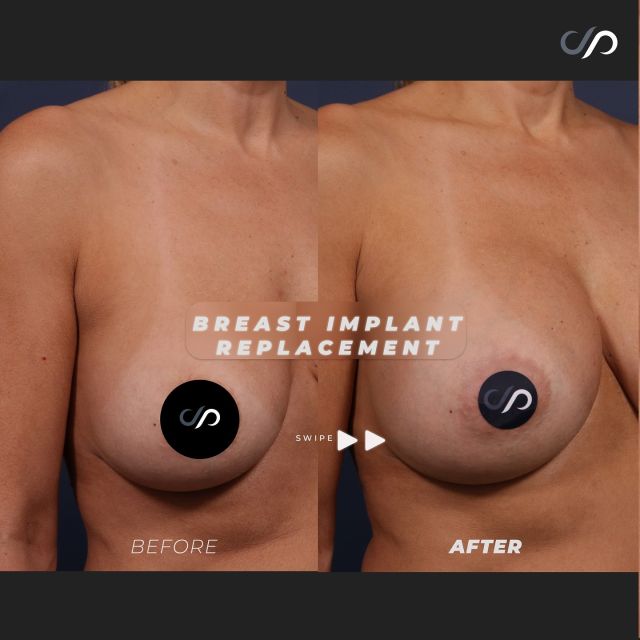 Breast Implant Replacement Results ✨💜✨ // #breastimplants

OUTCOME 💕
✨Fuller & Perkier Breasts
✨Natural Appearance 
✨Minimal Scarring

✅Our patient in her late 40s, upgraded her deflated saline implants. We replaced her original 325 cc implants with advanced cohesive silicone gel implants, increasing her size to 550 cc. 

👋BOOK NOW | in-office or virtual appointments by sending your name, number, and email to the DM.

📲 CALL US | questions regarding treatment: (310) 300-1779

🛍 SHOP SKINCARE | Link in bio 🔗

COMMENT BELOW ⬇️  .
.
.
.
#boobjob #breastimplants #gummybearimplants #breastimplantremoval #breastrevision  #beforeandafter #breastsurgery #breastimplants 	#cosmeticsurgery #plasticsurgery #boobjobexpert #breastaugmentationexpert #boardcertified #boardcertifiedplasticsurgeon #mastopexy #breastaug #breastreconstruction #plasticsurgeon #saggingbreast #breastlift #drstoker #postop #postopsurgery #beforeandaftersurgery