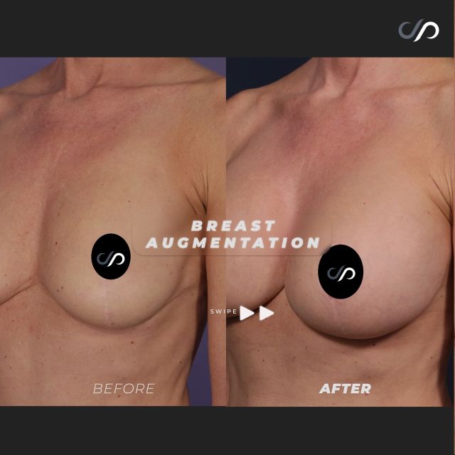 Breast Transformation!✨🍒✨// #breastlift #breastaugmentation 

✅ Fuller & Perky Breasts
✅ Larger Size
✅ Improve Cleavage 

👉We successfully completed breast surgery for our patient, enhancing her previous lift with a significant augmentation. We chose wider, moderate-profile implants for a balanced appearance. The lift was customized to match her body, resulting in an appealing look.

👋BOOK NOW | For in-office or virtual appointments, send your name, number, and email to the DM.

📲 CALL US | questions regarding treatment: (310) 300-1779

🛍 SHOP SKINCARE | Link in bio 🔗

COMMENT BELOW ⬇️  .
.
.
.

#breastimplant #plasticsurgery #breastaugmentation #breastlift #liposuction #tummytuck #cosmeticsurgery #plasticsurgeon #breastimplants #breastsurgery #boobjob #capsulectomy #aestheticsurgery #breast #mommymakeover #facelift #breastenlargement #cosmeticsurgeon #surgery #abdominoplasty #beforeandafter #mastopexy #beauty