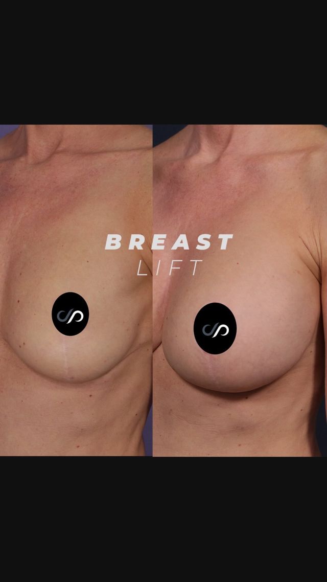 Breast Augmentation + Breast Lift ✨🍒✨// #breastlift #breastaugmentation 

🪄We successfully performed breast surgery on our patient, enhancing her previous lift with a significant augmentation. At 5’10”, we chose wider, moderate profile implants, estimating around 400 cc, to ensure a balanced look. We tailored the lift to complement her body perfectly, achieving an aesthetically pleasing result.

👋BOOK NOW | For in-office or virtual appointments, send your name, number, and email to the DM.

📲 CALL US | questions regarding treatment: (310) 300-1779

🛍 SHOP SKINCARE | Link in bio 🔗

COMMENT BELOW ⬇️  .
.
.
.
#reelsinstagram #reels #cosmeticsurgery #bodytransformation #implants #bodycontouring #recovery