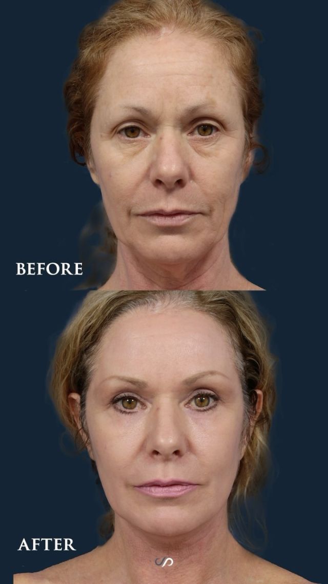 The Traceless Facelift 🥰// #facelift #necklift

Benefits of Facelift Surgery 👇
💜 Reduced Appearance of Fine Lines and Wrinkles
💜 Improved Facial Contours and Symmetry
💜 Youthful and Natural-Looking Results
💜 Boosted Confidence and Self-Esteem

😉Looking for a more youthful and refreshed appearance? Our face and neck lift surgery can help you turn back the clock and rejuvenate your appearance.

👋BOOK NOW | in-office or virtual appointments by sending your name, number, and email to the DM. 

📲 CALL US | questions regarding treatment: (310) 300-1779

📩Email: Info@drstoker.com

🛍 SHOP SKINCARE | Link in bio 🔗

COMMENT BELOW 🔽
.
.
.
.
#tracelessfacelift #facelift #necklift #skincare #cheeklift #lowerfacelift #laserskinresurfacing #blepharoplasty #upperbleph #uppereyelid #eyelidsurgery  #co2 #chinaugmentation #skinrejuvenation #skintightening  #cosmeticsurgery #wrinkles  #surgery #rejuvenation #skin #plasticsurgeon #transformation #plasticsurgery