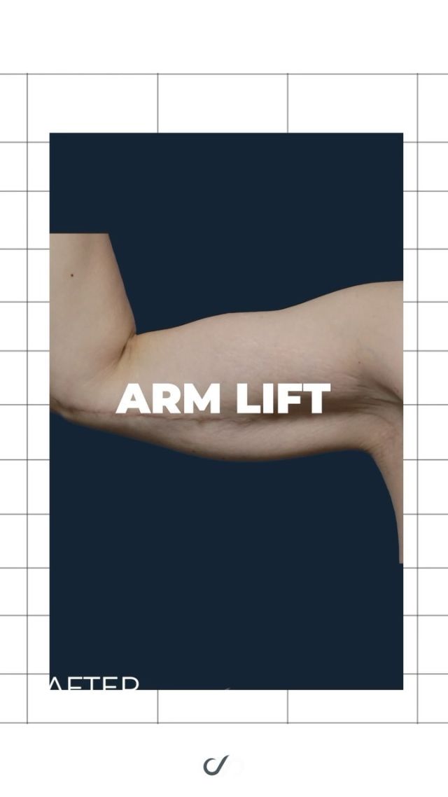 Arm Lift // Brachioplasty 🔥💪🔥 // #armlift #brachioplasty

✅Removal of Excess Skin 
✅Youthful Appearance 
✅Reduced Discomfort

✨Drooping and wrinkled arms can cause discomfort and impact self-esteem. Our brachioplasty, or arm lift surgery, eliminates surplus skin and fat, resulting in a rejuvenated and sculpted look in the upper arms. This transformative procedure boosts confidence and allows for the freedom to choose more comfortable attire, significantly enhancing overall quality of life.

👋BOOK NOW | In-office or virtual appointments by sending your name, number, and email to the DM.

📲 CALL US | questions regarding treatment: (310) 300-1779

🛍 SHOP SKINCARE | Link in bio 🔗 

COMMENT BELOW ⬇️ 
.
.
.
.
#bodylift #circumferentialbodylift #thighlift #weightloss #lowerbodylift #upperbodylift #tummytuck #abdominoplasty #mastopexy #skinremovalsurgery  #plasticsurgeryafterweightloss #extremeweightloss #extremebodymakeover  #fatremoval #bodytransformation #boardcertified  #plasticsurgeryresults #weightlosstransformation  #plasticsurgery #beforeandafterplasticsurgery #beforeandafter