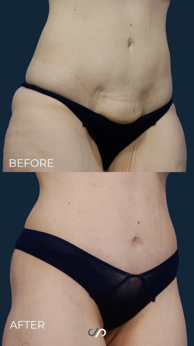 Circumferential Body Lift 👙💕// #bodylift #transformation

✨Two weeks after a circumferential body lift, the results for this patient are outstanding. The anterior thighs are smooth, and there’s a noticeable enhancement in the curves. 

✨The incision is strategically located beneath the bikini line, allowing for easy wear of regular clothing. While it’s still raised and in the healing phase, everything is progressing well.

👋BOOK NOW | In-office or virtual appointments by sending your name, number, and email to the DM.

📲 CALL US | questions regarding treatment: (310) 300-1779

🛍 SHOP SKINCARE | Link in bio 🔗

COMMENT BELOW 🔽
.
.
.
.
#skintightening  #bodytransformation #bbl #buttlift #buttockslift #plasticsurgery #lowerbody #tummytuck #plasticsurgeon #abdominoplasty #cosmeticsurgery #surgery #mommymakeover #beauty #physique #weightloss #weightlosstransformation #beforeandafter #bodycontouring #body #thighlift #boardcertifiedplasticsurgeon #bodyshaping #bodygoals #fitness