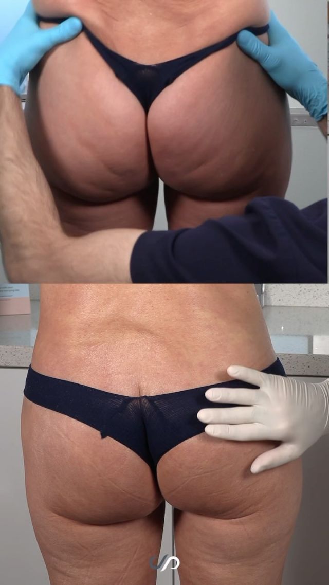 Outstanding BBL Results ✨🍑✨ // #BBL #buttlift

🔥Here’s a striking early post-operative result from a buttocks lift. The patient has developed a lovely curvature, thanks to our technique, which involves removing excess skin and enhancing fat for a more pronounced shape. Currently, her buttocks are impressively smooth with far less dimpling and laxity than before. 

✅We’ve effectively lifted and contoured the area, resulting in a dramatic transformation. She’s excited about the results, and it’s easy to see why.

👋BOOK NOW | In-office or virtual appointments by sending your name, number, and email to the DM.

📲 CALL US | questions regarding treatment: (310) 300-1779

🛍 SHOP SKINCARE | Link in bio 🔗

COMMENT BELOW ⬇️ 
.
.
.
.
#skintightening  #bodytransformation  #plasticsurgery #lowerbody #tummytuck #plasticsurgeon #abdominoplasty #cosmeticsurgery #surgery #mommymakeover #beauty #physique #weightloss #weightlosstransformation #beforeandafter #bodycontouring #body #thighlift #boardcertifiedplasticsurgeon #bodyshaping #bodygoals #fitness