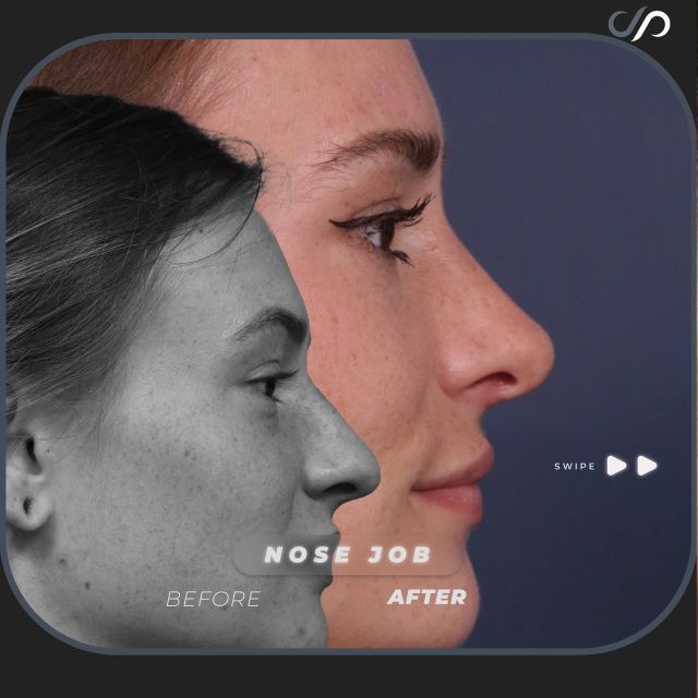 Nose Job // Rhinoplasty👃🔥 // #nosejob 

What Can A Nose Job Do For You? 
💞 Corrected Asymmetry
💞 Improved Breathing
💞 Profile Adjustment 

👋 BOOK NOW | In-office or virtual appointments by sending your name, number, and email to the DM. 

📲 CALL US | questions regarding treatment: (310) 300-1779

📩Email: Info@drstoker.com

🛍 SHOP SKINCARE | Link in bio 🔗

COMMENT BELOW 🔽
.
.
.
.
#rhinoplasty #nosejob #plasticsurgery #rinoplastia #nose #cosmeticsurgery #beauty #plasticsurgeon #nosesurgery #facelift #surgery #liposuction #botox #beforeandafter #rhinoplastyspecialist #revisionrhinoplasty #rhinoplastybeforeandafter #aesthetic #blepharoplasty #facialplasticsurgery