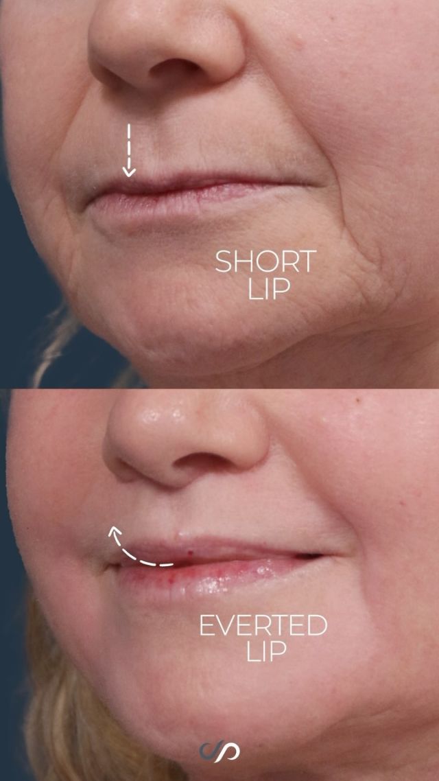 Upper Lip Lift w/ CO2 Laser 💋✨// #rejuvenation

RESULTS ✅
⚡️Enhanced Lip Curvature
⚡️Youthful & Natural Appearance
⚡️Diminished Wrinkles Around the Mouth
⚡️Improved Skin Texture

🤔Searching for a way to rejuvenate your smile and refresh your lips? Consider the lip lift procedure, an innovative treatment designed to combat common signs of aging around the mouth, such as increased spacing between the nose and upper lip, wrinkles, and textural changes.

🌟Our approach often combines an upper lip lift with fractional carbon dioxide laser resurfacing to achieve exceptional outcomes. By shortening the space between the nose & the pink vermillion and elevating the upper lip, we create a more youthful and natural appearance without the need for fillers. The result is a remarkably enhanced lip curvature, delivering a revitalized smile. You can confidently enjoy a refreshed and youthful look with improved skin texture and reduced wrinkles.

BOOK NOW | In-office or virtual appointments by sending your name, number, and email to the DM.

📲 CALL US | questions regarding treatment: (310) 300-1779

🛍 SHOP SKINCARE | Link in bio 🔗

COMMENT BELOW ⬇️ 
.
.
.
.
#tracelessfacelift #facelift #necklift #skincare #cheeklift #lowerfacelift #laserskinresurfacing #blepharoplasty #upperbleph #uppereyelid #eyelidsurgery  #co2 #chinaugmentation #skinrejuvenation #skintightening  #cosmeticsurgery #wrinkles  #surgery #rejuvenation #skin #plasticsurgeon #transformation #plasticsurgery