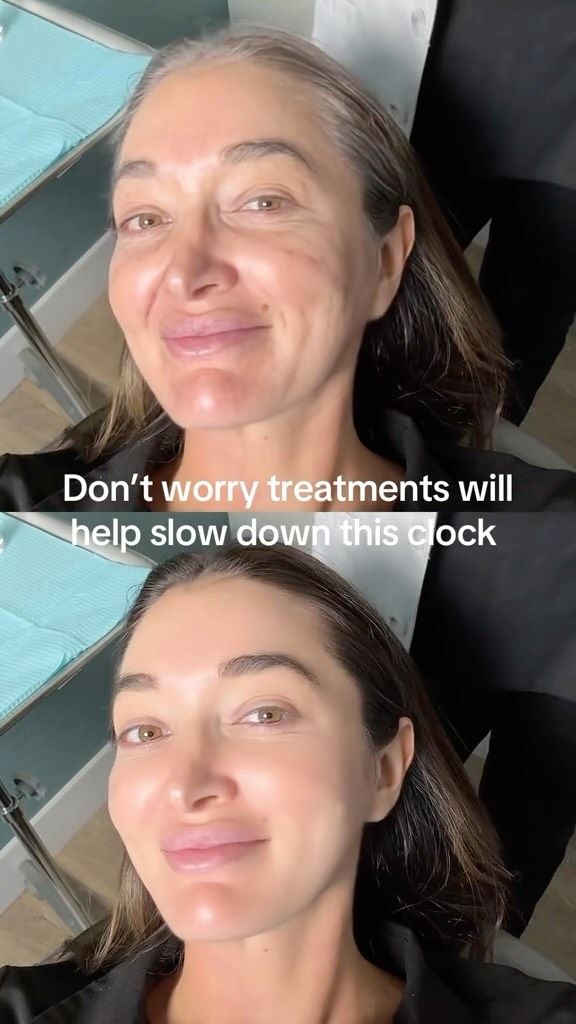 Non-Surgical Anti-Aging Treatments 💖 // #antiaging #medspa 

Learn more about some of our top non-surgical anti-aging treatments designed to rejuvenate your skin without the need for invasive or injectable  procedures:

💕Morpheus8: A cutting-edge treatment that combines microneedling with radiofrequency to stimulate collagen production, tighten, and smooth the skin.

💕CO2 Laser Resurfacing: This powerful laser treatment helps reduce fine lines, wrinkles, and scars, revealing a more youthful complexion.

💕Microneedling with PRP: Microneedling boosts skin repair, and when paired with Platelet-Rich Plasma (PRP), it accelerates healing and enhances skin renewal.

💕Melanage Peel: A chemical peel designed to lighten hyperpigmentation and improve skin tone for a smoother, more radiant look.

These treatments can help you achieve healthier, younger-looking skin with minimal downtime!

👋BOOK NOW | In-office or virtual appointments by sending your name, number, and email to the DM. 

📲 CALL US | questions regarding treatment: (310) 300-1779

📩Email: Info@drstoker.com

🛍 SHOP SKINCARE | Link in bio 🔗

COMMENT BELOW 🔽
.
.
.
.
#co2laser #botox #beauty #microneedling #aesthetics #fillers #morpheus8 #dermalfiller #medicalspa #juvederm #skin #lipfiller #injectables #plasticsurgery #facial #cheekfiller #lips #esthetician #aestheticsexpert #facials #selfcare #bodycontouring #restylane #laser #skincareroutine