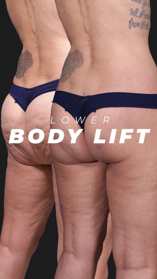 Five-Month Lower Body Lift Results 💞👙🛠️// #lowerbodylift #transformation

💕We’re excited to share the five-month postoperative results of a circumferential lower body lift on a 47-year-old patient. By removing excess skin and undermining the tissue, we achieved a fuller, smoother appearance. Minor dents from previous treatments have improved, and we plan to enhance her results with Sculptra injections.

💕Her transformation features youthful curves and a discreet incision line that will continue to fade. We’re thrilled with her progress and the boost in confidence this procedure has provided.

✅For more information on our body lift surgery or any other procedure, visit us at drstoker.com, where we have an extensive database of educational content, including our patients’ before and after results. 

BOOK NOW | In-office or virtual appointments by sending your name, number, and email to the DM.

📲 CALL US | questions regarding treatment: (310) 300-1779

🛍 SHOP SKINCARE | Link in bio 🔗

COMMENT BELOW 🔽
.
.
.
.
#skintightening  #bodytransformation #bbl #buttlift #buttockslift #plasticsurgery #lowerbody #tummytuck #plasticsurgeon #abdominoplasty #cosmeticsurgery #surgery #mommymakeover #beauty #physique #weightloss #weightlosstransformation #beforeandafter #bodycontouring #body #thighlift #boardcertifiedplasticsurgeon #bodyshaping #bodygoals #fitness