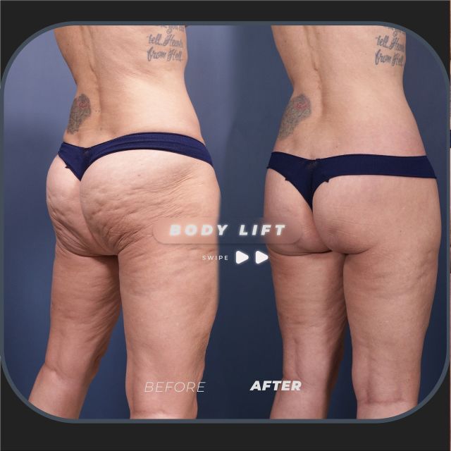 Lower Body Lift Results // 5-Months 🛠️// #lowerbodylift #transformation

OUTCOME ⬇️
❣️Improved Cellulite
❣️Lifted Buttocks
❣️Smooth Skin

💕 By performing a lower body lift on this 47-year-old patient, we removed excess skin and reshaped the underlying tissue, resulting in a fuller, smoother silhouette. Her transformation showcases youthful curves and a discreet incision line that will continue to fade with time.

✅For more information on our body lift surgery or any other procedure, visit us at drstoker.com, where we have an extensive database of educational content, including our patients’ before and after results. 

👋 BOOK NOW | In-office or virtual appointments by sending your name, number, and email to the DM.

📲 CALL US | questions regarding treatment: (310) 300-1779

🛍 SHOP SKINCARE | Link in bio 🔗

COMMENT BELOW 🔽
.
.
.
.
#skintightening  #bodytransformation #bbl #buttlift #buttockslift #plasticsurgery #lowerbody #tummytuck #plasticsurgeon #abdominoplasty #cosmeticsurgery #surgery #mommymakeover #beauty #physique #weightloss #weightlosstransformation #beforeandafter #bodycontouring #body #thighlift #boardcertifiedplasticsurgeon #bodyshaping #bodygoals #fitness