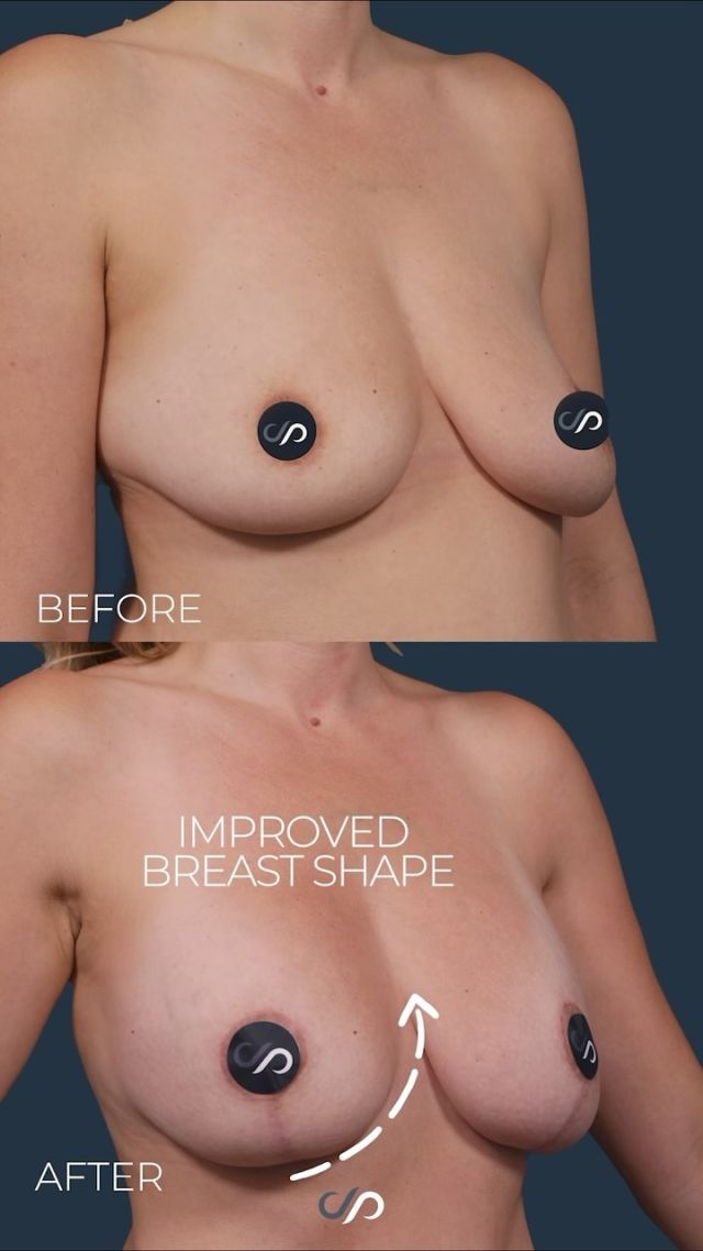 Breast Lift Surgery 🍒✨ // #breastlift 

RESULTS 🍒   
✅Rejuvenated Appearance 
✅Repositioned Nipples 
✅Lifted Breasts

✨Women frequently experience a loss of youthful breast shape due to factors such as pregnancy, weight loss, or aging. Over time, breast skin can lose elasticity, resulting in drooping and sagging. 

✨A breast lift procedure aims to restore the position and shape of the breasts. This typically involves removing excess skin and tissue, followed by elevating the nipples to a higher position.

👋 BOOK NOW | in-office or virtual appointments by sending your name, number, and email to the DM. 

📲 CALL US | questions regarding treatment: (310) 300-1779

📩Email: Info@drstoker.com

🛍 SHOP SKINCARE | Link in bio 🔗

COMMENT BELOW 🔽
.
.
.
.
#breastimplants #breastimplant #breastimplantrevision #revisionsurgery #bodycontouring #breastliftrevision #plasticsurgery #breastaug #breastaugmentation #implants #breast #boobjob #breasts #mastopexy #beforeandafterplasticsurgery #beforeandafter #postop #breastenhancement #surgery #boardcertifiedplasticsurgeon #boardcertified #gummybearimplants #postopresults