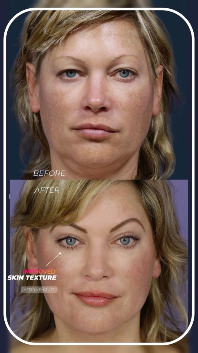 The Traceless Facelift 🥰// #facelift #necklift

Benefits of Facelift Surgery 👇
💜 Reduced Appearance of Fine Lines and Wrinkles
💜 Improved Facial Contours and Symmetry
💜 Youthful and Natural-Looking Results
💜 Boosted Confidence and Self-Esteem

😉Looking for a more youthful and refreshed appearance? Our face and neck lift surgery can help you turn back the clock and rejuvenate your appearance.

👋BOOK NOW | in-office or virtual appointments by sending your name, number, and email to the DM. 

📲 CALL US | questions regarding treatment: (310) 300-1779

📩Email: Info@drstoker.com

🛍 SHOP SKINCARE | Link in bio 🔗

COMMENT BELOW 🔽
.
.
.
.
#tracelessfacelift #facelift #necklift #skincare #cheeklift #lowerfacelift #laserskinresurfacing #blepharoplasty #upperbleph #uppereyelid #eyelidsurgery  #co2 #chinaugmentation #skinrejuvenation #skintightening  #cosmeticsurgery #wrinkles  #surgery #rejuvenation #skin #plasticsurgeon #transformation #plasticsurgery