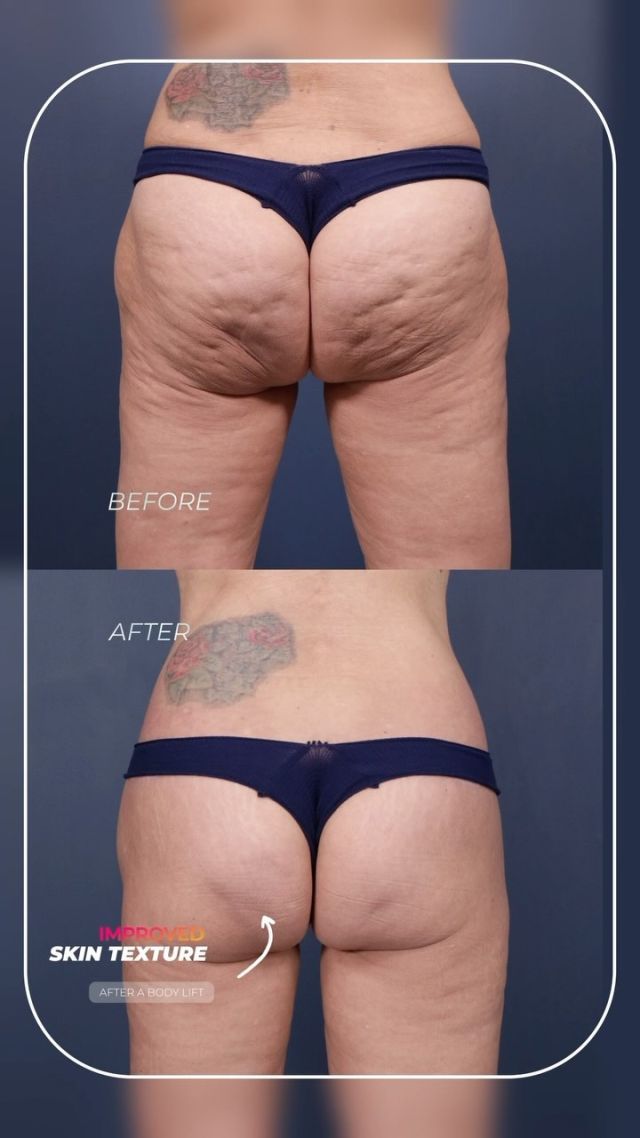 Circumferential Lower Body Lift 🥰// #lowerbodylift #transformation
 What Does A Lower Body Lift Typically Include:
✅Tummy Tuck
✅Thigh Lift
✅Buttocks lift

For more information on our body lift surgery or any other procedure, just visit us at drstoker.com, where we have a large database of educational content including our patients’ before and after results. 

👋 BOOK NOW | in-office or virtual appointments by sending your name, number, and email to the DM.

📲 CALL US | questions regarding treatment: (310) 300-1779

🛍 SHOP SKINCARE | Link in bio 🔗
.
.
.
.
#skintightening  #bodytransformation #bbl #buttlift #buttockslift #plasticsurgery #lowerbody #tummytuck #plasticsurgeon #abdominoplasty #cosmeticsurgery #surgery #mommymakeover #beauty #physique #weightloss #weightlosstransformation #beforeandafter #bodycontouring #body #thighlift #boardcertifiedplasticsurgeon #bodyshaping #bodygoals #fitness