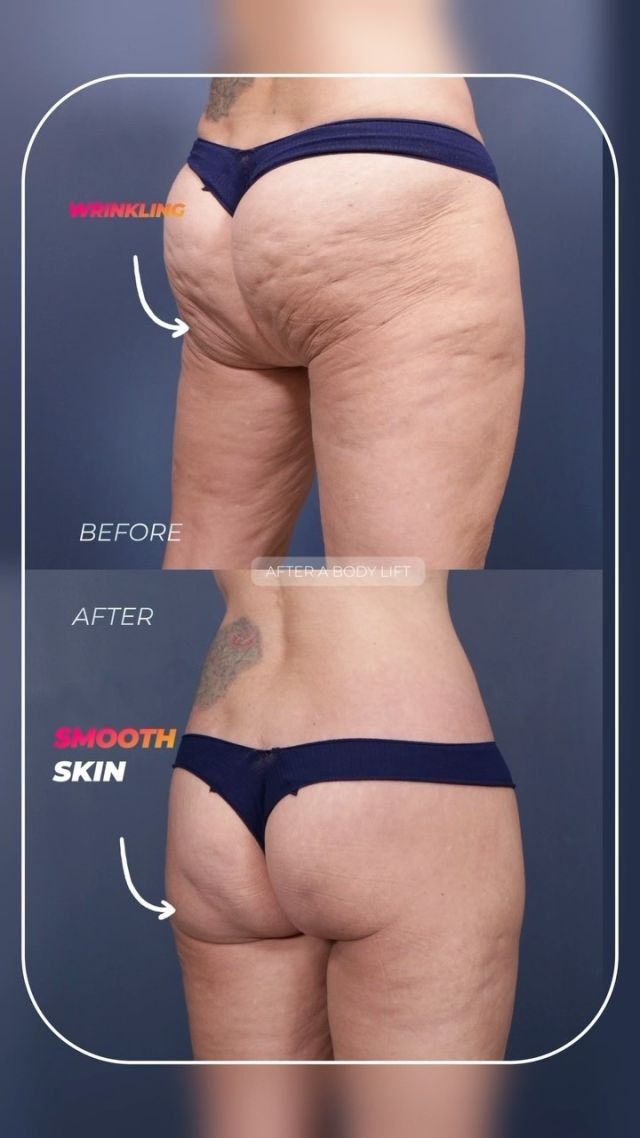 Circumferential Lower Body Lift 🥰// #lowerbodylift #transformation
 What Does A Lower Body Lift Typically Include:
✅Tummy Tuck
✅Thigh Lift
✅Buttocks lift

For more information on our body lift surgery or any other procedure, just visit us at drstoker.com, where we have a large database of educational content including our patients’ before and after results. 

👋 BOOK NOW | in-office or virtual appointments by sending your name, number, and email to the DM.

📲 CALL US | questions regarding treatment: (310) 300-1779

🛍 SHOP SKINCARE | Link in bio 🔗
.
.
.
.
#skintightening  #bodytransformation #bbl #buttlift #buttockslift #plasticsurgery #lowerbody #tummytuck #plasticsurgeon #abdominoplasty #cosmeticsurgery #surgery #mommymakeover #beauty #physique #weightloss #weightlosstransformation #beforeandafter #bodycontouring #body #thighlift #boardcertifiedplasticsurgeon #bodyshaping #bodygoals #fitness