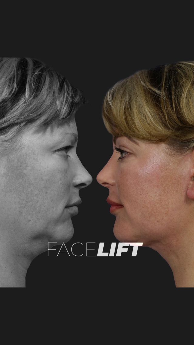 Traceless Facelift 😉✨ // #facelift  #beforeandafter 

💕We performed our Traceless Face and Neck Lift technique along with upper eyelid surgery, focusing on two key aspects: effectively repositioning deep and superficial tissues without creating an artificial appearance, often seen as a “windblown” look. 

💕The upper eyelid surgery is particularly impactful, allowing us to remove excess skin, muscle, and fat while maintaining natural curvature. The result is a rejuvenated look, making her eyelids appear up to 20 years younger.

👋BOOK NOW | In-office or virtual appointments by sending your name, number, and email to the DM.

📲 CALL US | questions regarding treatment: (310) 300-1779

🛍 SHOP SKINCARE | Link in bio 🔗 

COMMENT BELOW 🔽
.
.
.
.
#tracelessfacelift #facelift #necklift #skincare #cheeklift #lowerfacelift #laserskinresurfacing #blepharoplasty #upperbleph #uppereyelid #eyelidsurgery  #co2laser #chinaugmentation #skinrejuvenation #skintightening  #cosmeticsurgery #wrinkles  #surgery #rejuvenation #skin #plasticsurgeon #transformation #plasticsurgery