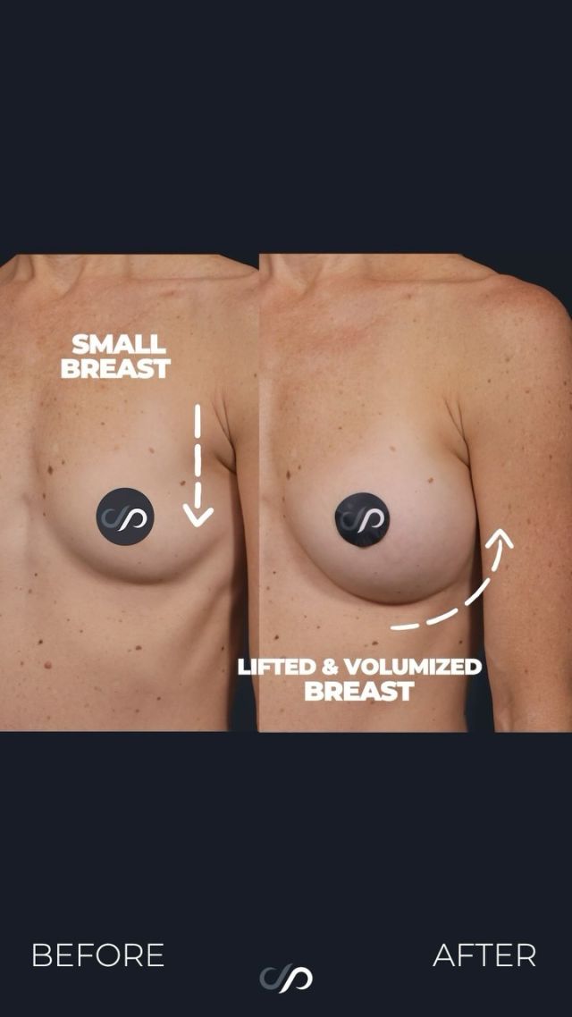 Rapid Recovery Breast Augmentation 🍒💫🍒 // #breastaugmentation #recovery

Our practice specializes in rapid recovery techniques that are designed to give our patients the freedom to get back to their normal lives as soon as possible after breast augmentation surgery. 

What are the steps of a Rapid Recovery Breast Augmentation?
👉Minimizing Trauma During the Procedure
👉Precise Creation of Implant Pockets
👉Touch-Free Augmentation
👉Use of Long-Lasting Local Anesthetic 
Visit our website, drstoker.com, to learn more about our rapid recovery procedures and determine which surgery is best for you. 

 BOOK NOW | in-office or virtual appointments by sending your name, number, and email to the DM.

📲 CALL US | questions regarding treatment: (310) 300-1779

🛍 SHOP SKINCARE | Link in bio 🔗

COMMENT BELOW ⬇️  .
.
.
.
#breastaugmentation #boobjob #breastimplants #gummybearimplants #breastenlargement #beforeandafter #breastsurgery #breastimplant #cosmeticsurgery #plasticsurgery #boobjobexpert #breastaugmentationexpert #boardcertified #boardcertifiedplasticsurgeon #mastopexy #breastaug #breastreconstruction #plasticsurgeon #breastlift #postop #postopsurgery #beforeandaftersurgery