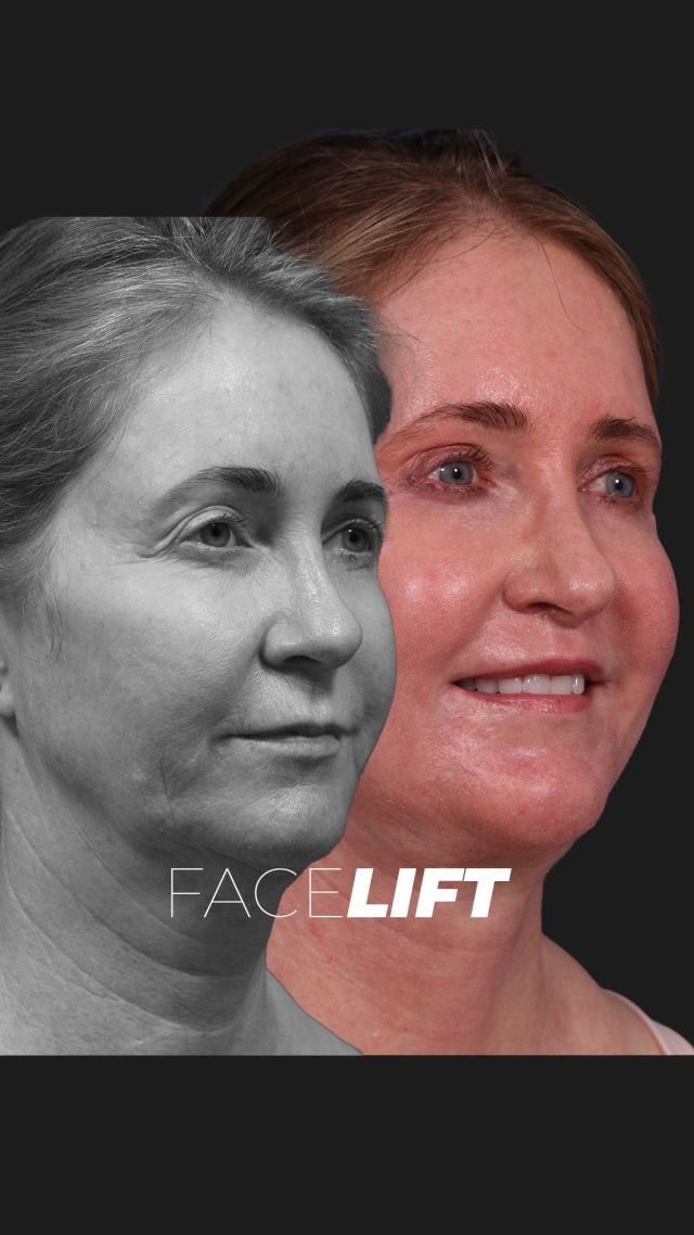 Refreshing Traceless Facelift ⏱️💞 // #facelift  #beforeandafter 

✨Seven weeks post-op from panfacial rejuvenation, and the results are stunning. Her eyes are brighter, more vivid, and her smile is now confident, thanks to the lip lift. Wrinkles are nearly gone, with smooth, youthful skin and no more nasolabial folds or marionette lines.

✨The skin has been resurfaced with fractional CO2 laser, leaving it fresh and clear. Incisions are virtually invisible. The eyelid incisions are hidden in the natural fold, lip lift incisions are discreet under the nose, and traceless incisions along the sides show only minimal redness.

👋BOOK NOW | In-office or virtual appointments by sending your name, number, and email to the DM.

📲 CALL US | questions regarding treatment: (310) 300-1779

🛍 SHOP SKINCARE | Link in bio 🔗 

COMMENT BELOW 🔽
.
.
.
.
#tracelessfacelift #facelift #necklift #skincare #cheeklift #lowerfacelift #laserskinresurfacing #blepharoplasty #upperbleph #uppereyelid #eyelidsurgery  #co2laser #chinaugmentation #skinrejuvenation #skintightening  #cosmeticsurgery #wrinkles  #surgery #rejuvenation #skin #plasticsurgeon #transformation #plasticsurgery