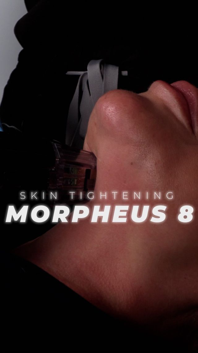 Morpheus8 // Skin Tightening 🤩 #morpheus8 

✨Morpheus8 is a microneedling treatment with RF technology that boosts collagen and tightens skin. It works for all skin types and ages, with results starting in 3–4 weeks and continuing for up to 6 months. Most patients begin with 3–4 treatments, spaced 4 weeks apart, but plans are customized to each person.

✨Morpheus targets areas like the chin to reduce fat and tighten skin, and it’s great for improving skin laxity, pores, acne scars, and necklace lines. It’s an ideal maintenance treatment, especially for those over 30 looking to refresh and maintain healthy, youthful skin.

👋BOOK NOW | In-office or virtual appointments by sending your name, number, and email to the DM.

📲 CALL US | questions regarding treatment: (310) 300-1779

🛍 SHOP SKINCARE | Link in bio 🔗 

COMMENT BELOW 🔽
.
.
.
.
#tracelessfacelift #facelift #necklift #skincare #cheeklift #lowerfacelift #laserskinresurfacing #blepharoplasty #upperbleph #uppereyelid #eyelidsurgery  #co2laser #chinaugmentation #skinrejuvenation #skintightening  #cosmeticsurgery #wrinkles  #surgery #rejuvenation #skin #plasticsurgeon #transformation #plasticsurgery