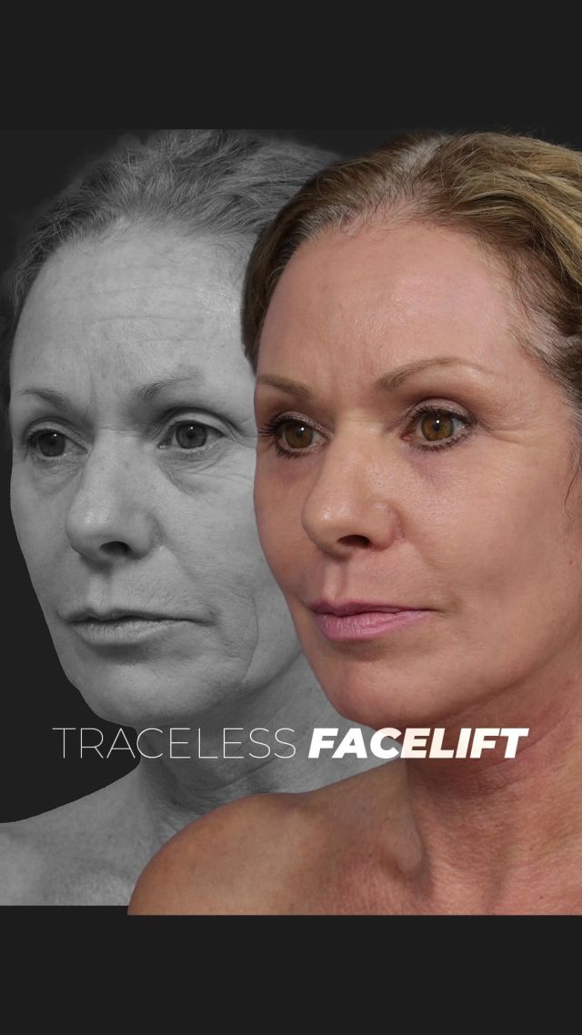 Traceless Facelift 🤯🔥 // #facelift 

OUTCOME 🙋‍♀️
💕Younger-Looking Appearance
💕Improved Skin Texture
💕Discreet Incisions 

✨Facelifts are designed to reverse signs of aging in the face that occur due to the loss of elasticity in the skin. The surgery tightens and lifts the skin of the face for optimal facial rejuvenation. Incisions are placed in discreet locations to go unnoticed, leaving no trace of a procedure. 

✨Our patients who undergo this procedure are given a new lease on life by turning the clock back. This procedure is often combined with CO2 laser resurfacing, which is ideal for stimulating collagen for firmer and youthful skin. 

👋BOOK NOW | in-office or virtual appointments by sending your name, number, and email to the DM. 

📲 CALL US | questions regarding treatment: (310) 300-1779

📩Email: Info@drstoker.com

🛍 SHOP SKINCARE | Link in bio 🔗

COMMENT BELOW 🔽
.
.
.
.
#rejuvenation #tracelessfacelift #faceliftexpert  #skincare #cheeklift #lowerfacelift #laserskinresurfacing #blepharoplasty #upperbleph #uppereyelid #eyelidsurgery  #co2 #chinaugmentation #skinrejuvenation #skintightening  #cosmeticsurgery #wrinkles  #surgery #rejuvenation #skin  #antiaging #plasticsurgeon #transformation #plasticsurgery