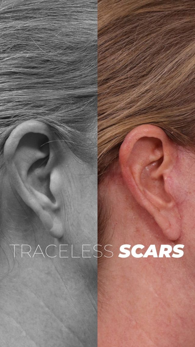 Traceless Scars 🪄 💝// #facelift  #beforeandafter 

✅At just six and a half weeks post-facelift, the scars are virtually undetectable. Hidden in the hairline with hair follicles already growing through, the incision follows the natural curve of the ear and is smooth with only a hint of pink. Behind the ear, it’s tucked in the crease, completely out of sight. This is a true Traceless Facelift.

👋BOOK NOW | In-office or virtual appointments by sending your name, number, and email to the DM.

📲 CALL US | questions regarding treatment: (310) 300-1779

🛍 SHOP SKINCARE | Link in bio 🔗 

COMMENT BELOW 🔽
.
.
.
.
#tracelessfacelift #facelift #necklift #skincare #cheeklift #lowerfacelift #laserskinresurfacing #blepharoplasty #upperbleph #uppereyelid #eyelidsurgery  #co2laser #chinaugmentation #skinrejuvenation #skintightening  #cosmeticsurgery #wrinkles  #surgery #rejuvenation #skin #plasticsurgeon #transformation #plasticsurgery